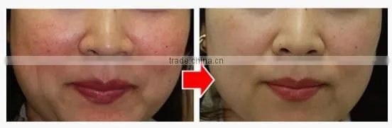 Distributors wanted Medical Q-switche laser 1064nm ND YAG home alexandrite laser hair removal machine