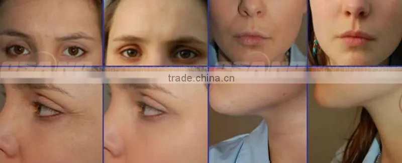 Portable Personal Massager rf Face Skin Lifting Equipment for Wrinkles & Eyelid ( 2 Changeable Heads): Best Results High quality