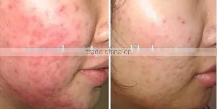 M-N103 microneedle derma skin rollers