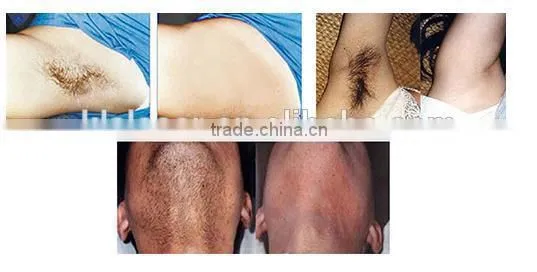 hot newest Germany 808nm diodes laser hair removal product