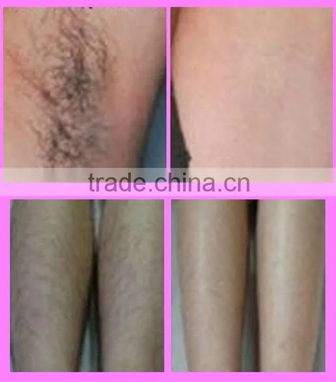 SHR and elight hair removal machine
