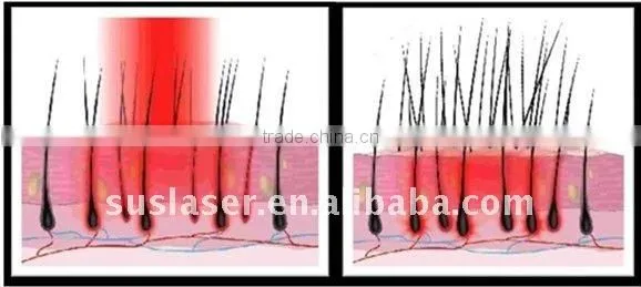 BL002 Hair Loss Treatment PDT LED Light Therapy For Hair Loss Treatment