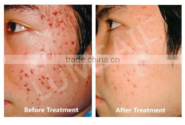 Photodynamic led red light therapy equipment