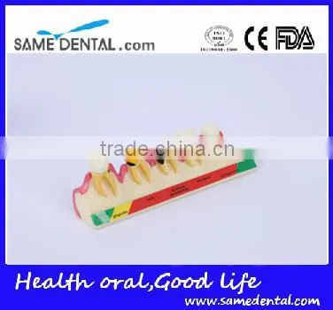 2x periodontal disease classification models Dental Eduction Assitant No. DEA-20