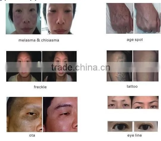 2016 new touch screen tattoo removal machine nd yag laser machine prices