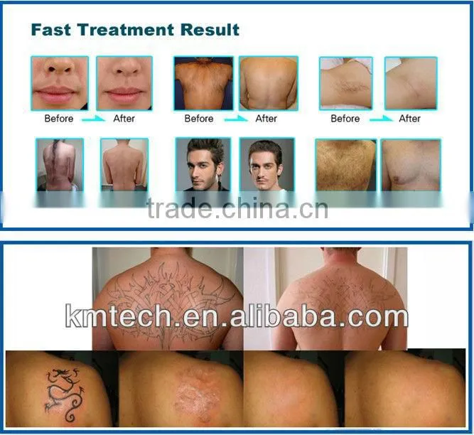 2014 cheap and convinient ipl hair removal home use with CE ISO TUV SFDA
