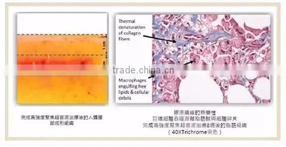 slimming beauty machine liposonix depilatory machine