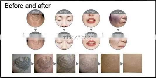 Q switched Nd Yag carbon Laser for skin rejuvenation