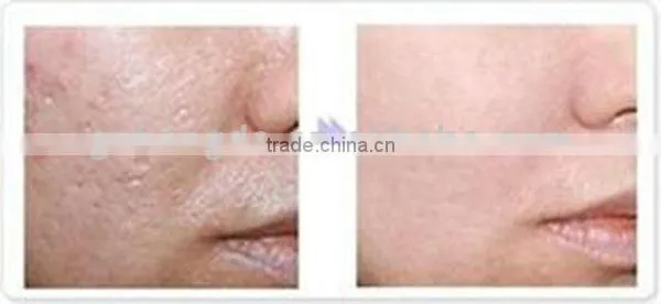 2013 Newest product! permanent lazer home hair removal device for the whole body BD-J005