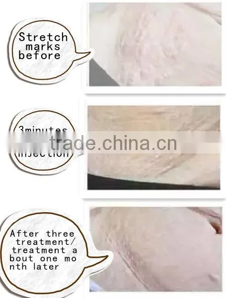 carboxy therapy equipment /carboxy therapy machine