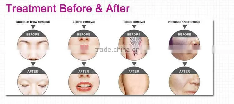 New professional manufacturer lipline removal,laser tattoo removal machine