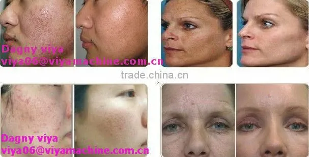 VY-V500 Hottest fractional rf system with 7 heads for sale
