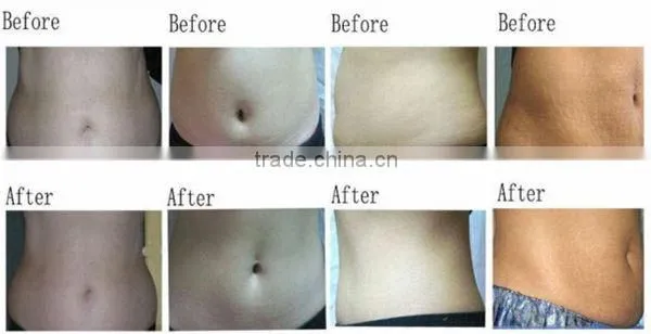 Freezing Fat Away Weight Loss Ice Sculpt Cryolipolyse