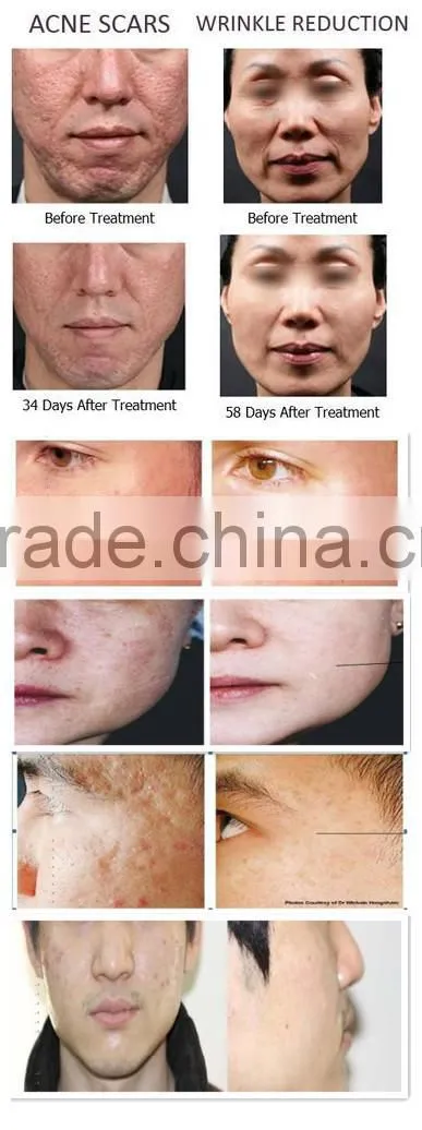 Fractional rf microneedle scar removal/fractional rf microneedle stretch marks removal/fractional rf microneedle wrinkle removal