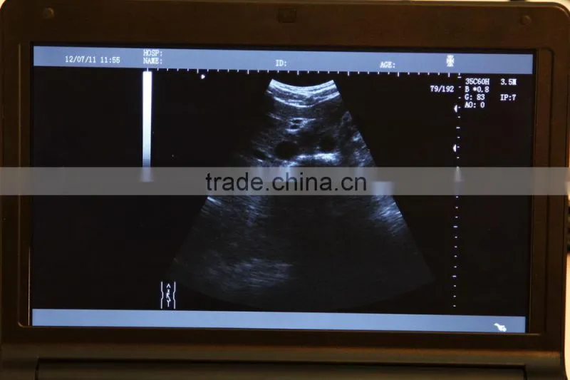 CE approved Laptop Ultrasound Scanner RUS-9000F with 3.5Mhz convex probe and 7.5Mhz linear probe
