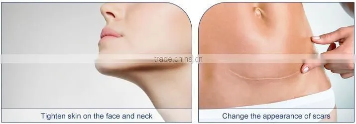 Weifang KM fractional co2 rf laser with best price hot selling