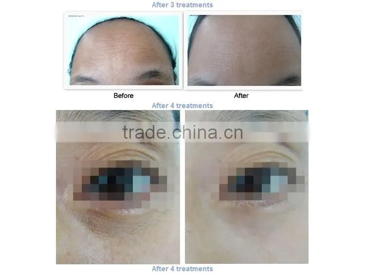 Home use RF wrinkle treatment/rf skin rejuvenation for sale