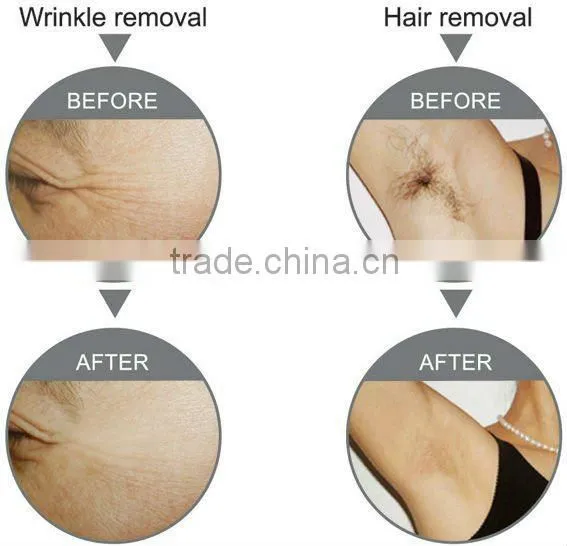 Powerful SHR (super hair removal) beauty machine