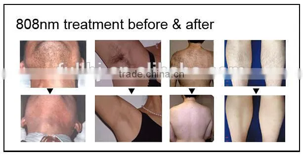 permanent hair removal/Professional New Diode 808nm Laser Hair Removal machine