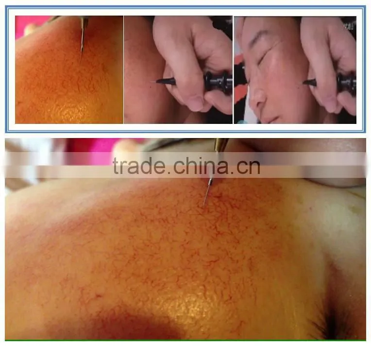 Portable laser pigmentation removal and spider vein removal machine