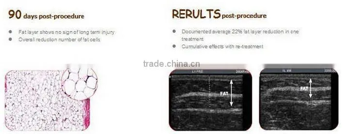 New prodcut on market cooling system fat dessolving/fat reduction /fat removal machine
