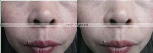 Promotion! most advanced spider vein
