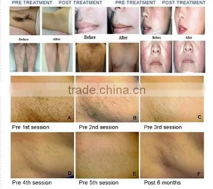 808nm laser diode price/cheap laser hair removal machine/808nm 5w laser diode