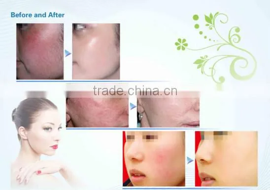 Factory price! the latest spider vein removal machine/ 24 hours continuous work