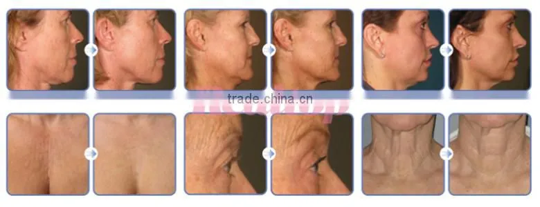 New Technology korea hifu hifu skin tightening machine for hifu slimming