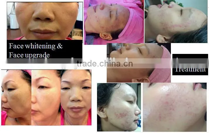 oxygen spray / oxygen infusion / oxygen machine for skin care