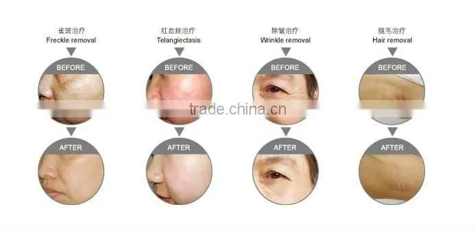 Newest acne removal face skin tightening therapy machine with IPL&RF