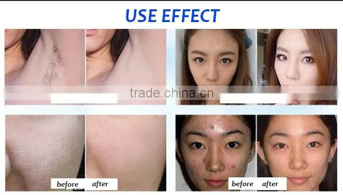 2016 Most popular beauty equipment 4in1 RF/OPT/Laser/Elight Hair Removal Machine