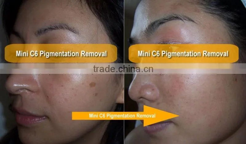 IPL rf nd yag laser hair removal machine / Q switch mini nd yag laser machine