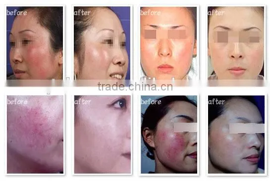 opt with ipl shr faster hair removal in motion than 808nm diode laser