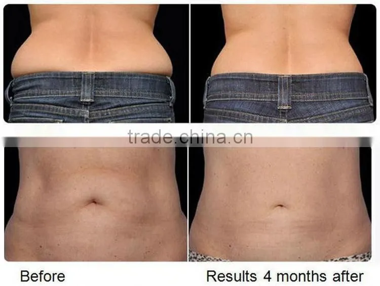 best 650nm lipo laser fat burning laser beauty machine