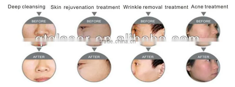 IPL E-LIGHT RF beauty machine with powerful cooling system to remove excess hair