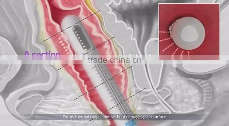 Ultrasonic System HIFU Vaginal Machine China Supplier