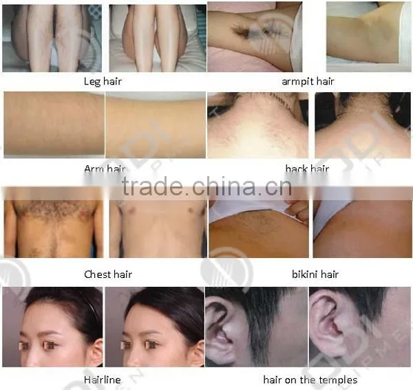 (CE)2013 best laser hair removal machine with 808nm wavelength (OD-LS808)