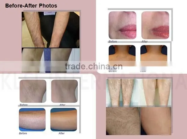 810nm diode laser for hair removal system with permanent results