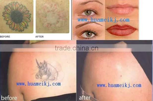 Q switched nd yag laser /tattoo removal beauty machine /laser tattoo removal with CE