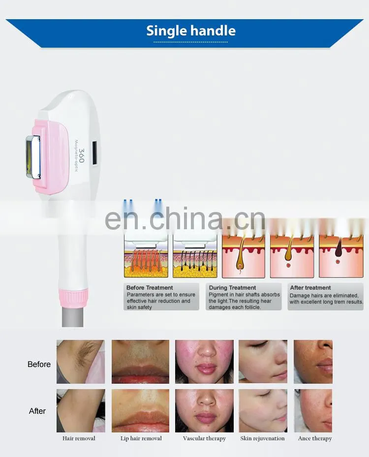 Laser Ipl Hair Removal Skin Rejuvenation Handset Beauty Equipment Light Focus Bikini Lamp Key Sales Lips Machine