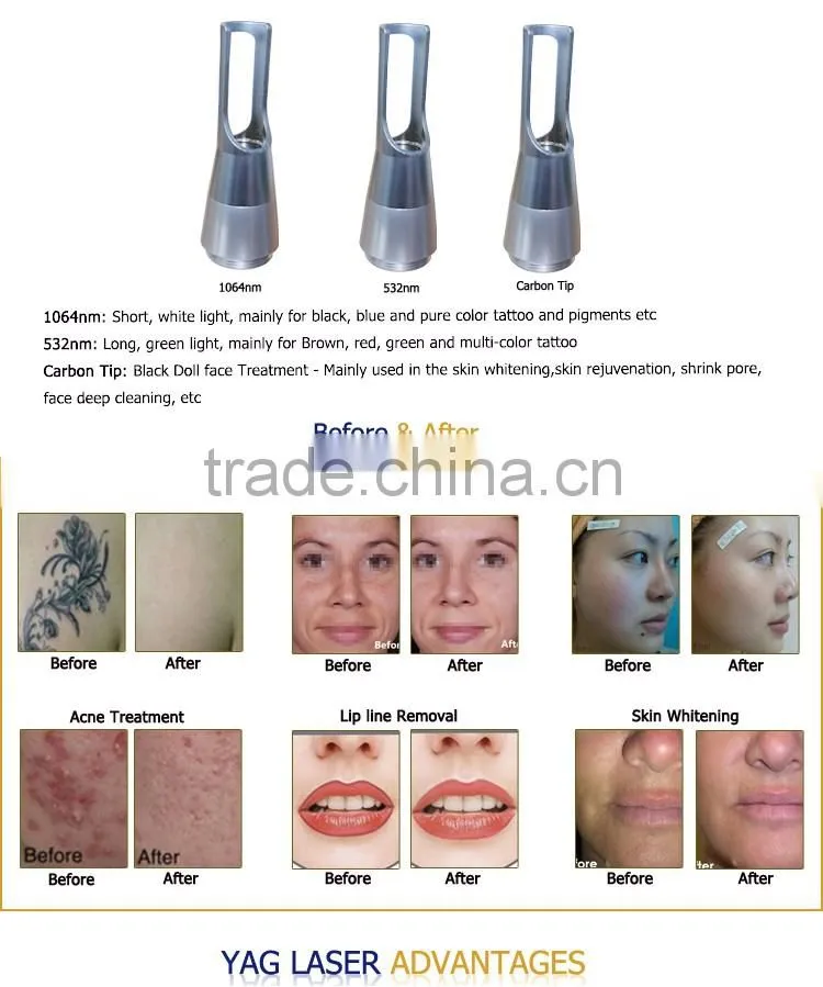 Best laser tattoo treatment machine nd yag tattoo removal laser machine