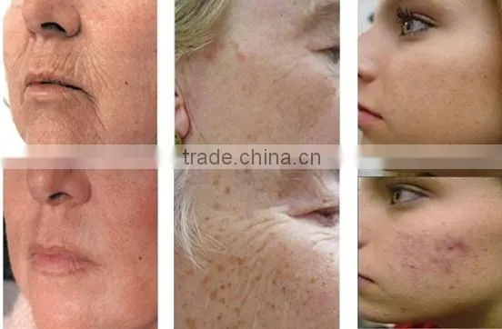 SHR IPL Elight Acne Scar Removal Machine/ Home Permanent Hair Removal