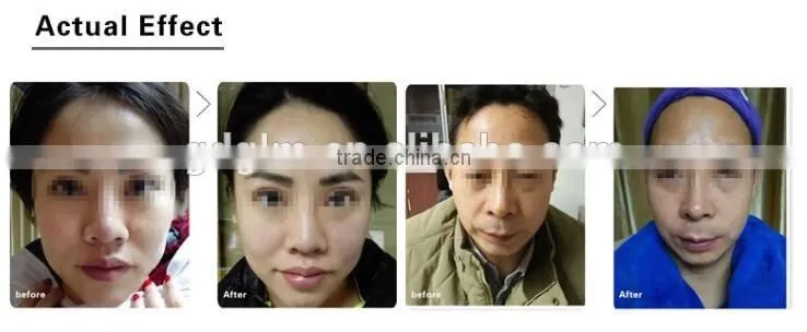 home use hifu glm hottest ultrasonic HIFU face lifting device