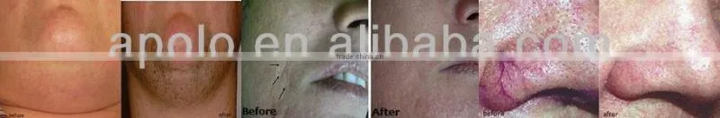 1064nm Long pulse Nd YAG laser