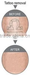 New product in 2015 q switch nd yag laser tattoo removal system q-switched nd yag laser nd yag laser in china