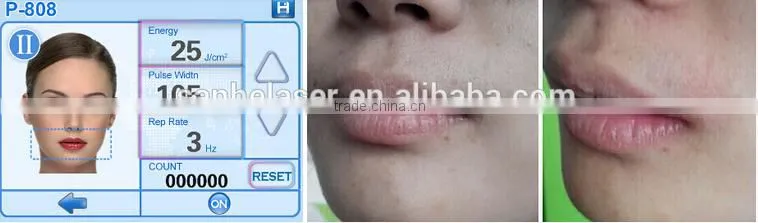 Portable big spot size 12*23mm diode laser hair removal 808 nm machine with high power and good effect