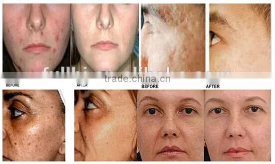 2940nm Er yag laser skin treatment machine