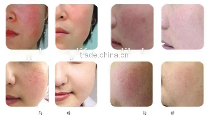 Spider Vein Removal Laser