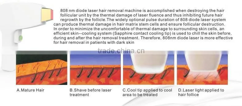 Hot selling Vertical Permanent Hair Removal With CE